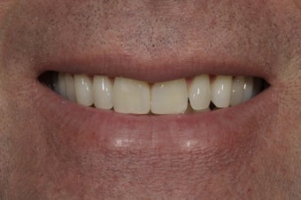 Closing a space between the front teeth with dental bonding
