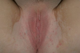 Labiaplasty