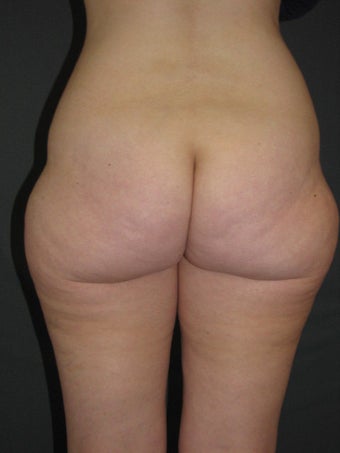 Smart Lipo of Hips, Saddle Bags, and Inner Thighs