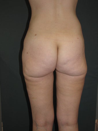 Smart Lipo of Hips, Saddle Bags, and Inner Thighs