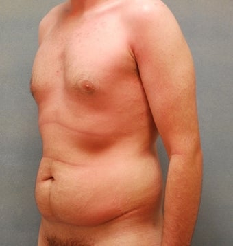 Abdominoplasty