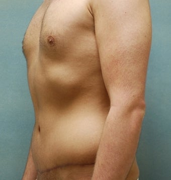 Abdominoplasty