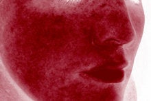 Laser Genesis for Overall Redness