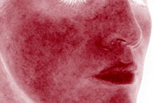 Laser Genesis for Overall Redness