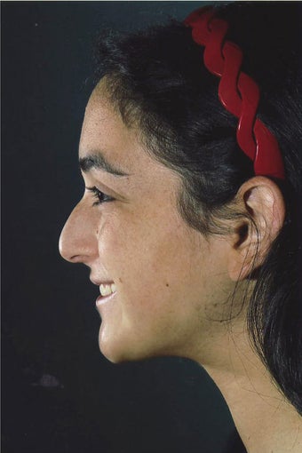 Rhinoplasty