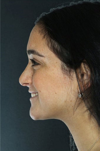 Rhinoplasty