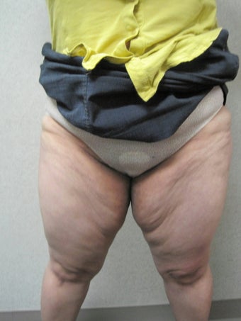 Inner Thigh Lift