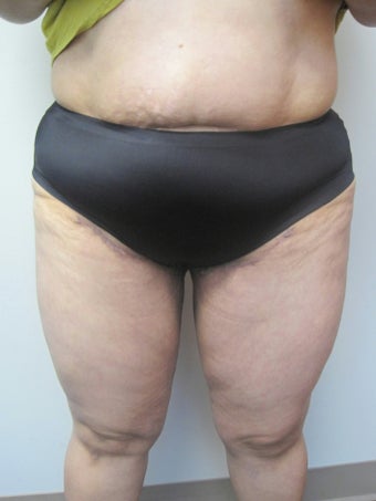 Inner Thigh Lift