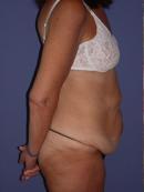 Body Lift