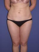 Thigh Lift