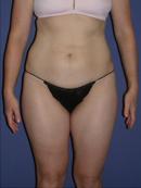 Thigh Lift