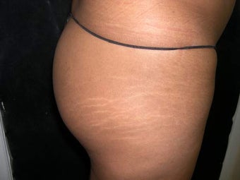 Butt Lift