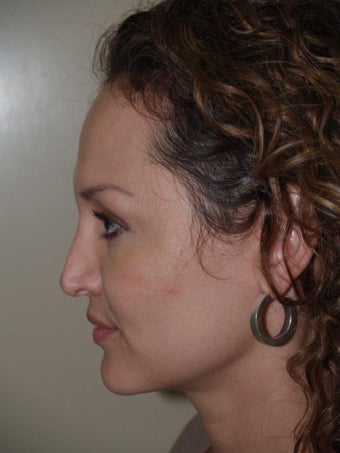 Revision Rhinoplasty