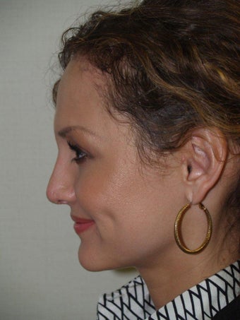 Revision Rhinoplasty