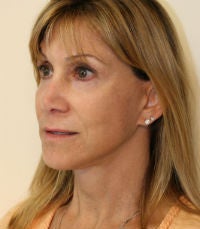 facelift