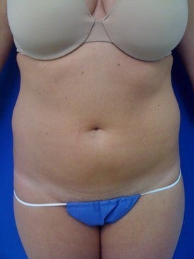 Laser Lipo