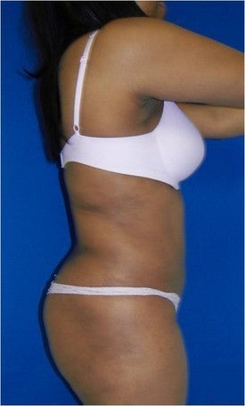 Laser Lipo