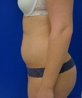 Laser Lipo