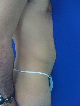 Laser Lipo