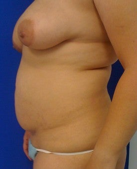Laser Lipo