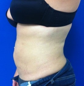 Laser Lipo