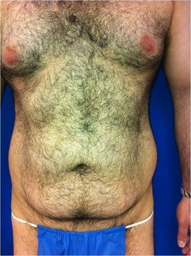 Laser Lipo