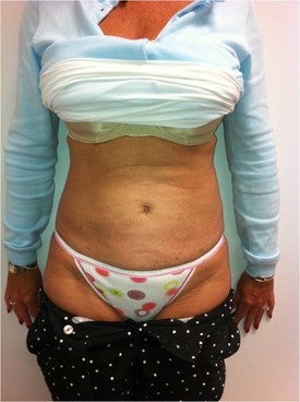 Laser Lipo