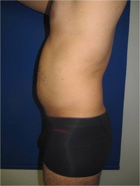 Laser Lipo