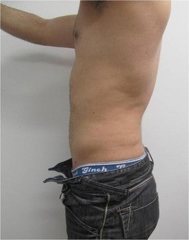Laser Lipo