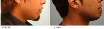 Upper and Lower Lip Reduction