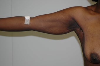 Arm Lift (brachioplasty)
