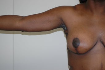 Arm Lift (brachioplasty)