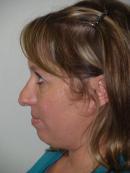 Revision Rhinoplasty