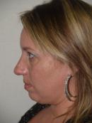 Revision Rhinoplasty