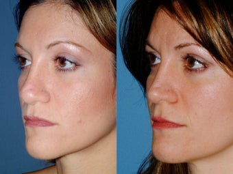 Revision rhinoplasty
