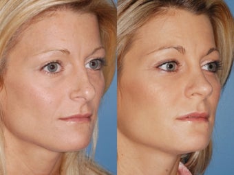 Revision rhinoplasty