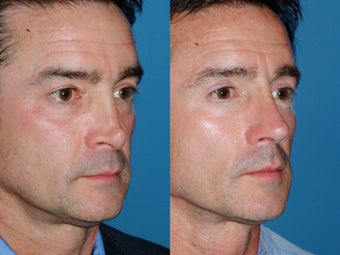 Revision rhinoplasty