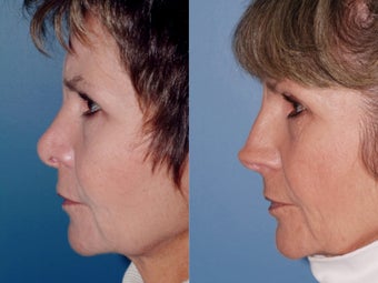 Revision rhinoplasty