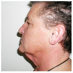 Upper and lower eyelid surgery, face lift, neck lift, and brow lift.
