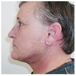 Upper and lower eyelid surgery, face lift, neck lift, and brow lift.