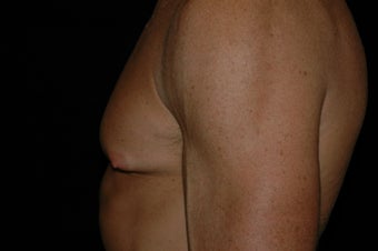 Gynecomastia surgery
