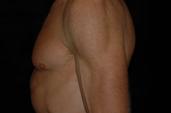 Gynecomastia surgery