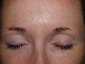 Eyebrow Transplant