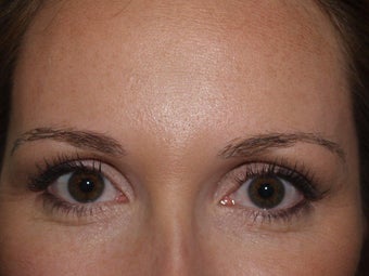 Eyebrow Transplant