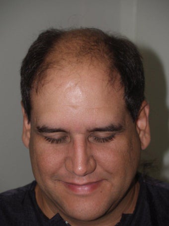 Hair Transplant