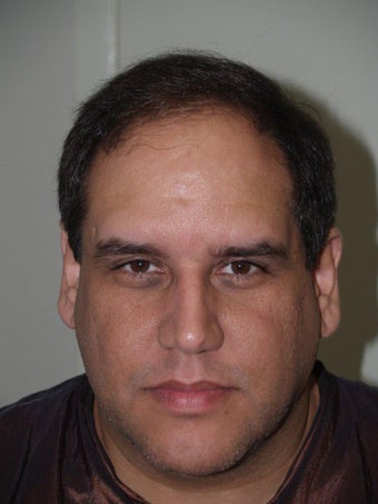 Hair Transplant