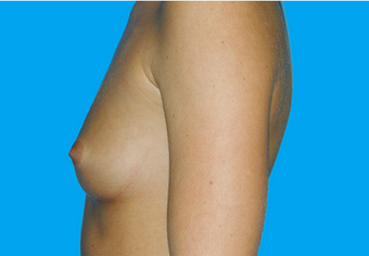 Breast Augmentation