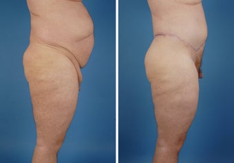 Upper & Lower Body Lift