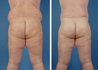 Upper & Lower Body Lift