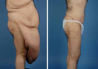 Body Lift